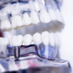 Ile kosztują implanty dentystyczne