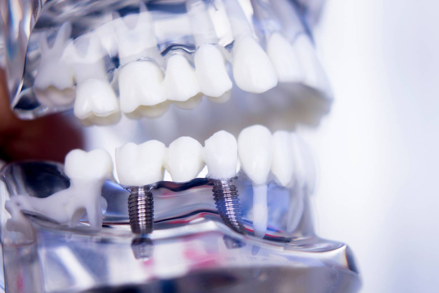 Ile kosztują implanty dentystyczne
